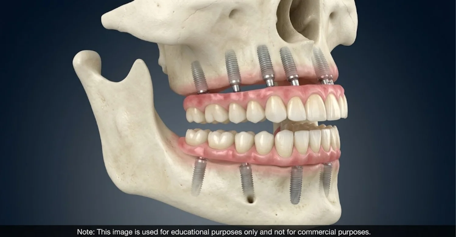 Full Mouth Dental Implants 2